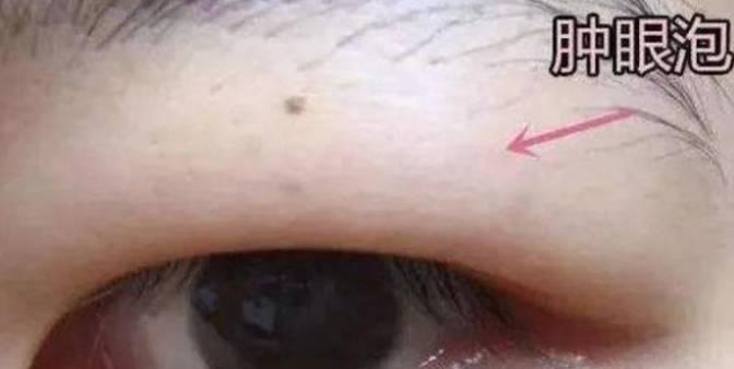 手術(shù)消除腫眼泡做完要多久時間？