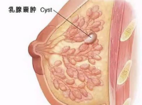 哺乳期乳腺囊腫怎么辦？