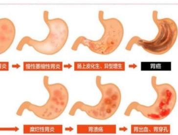 胃潰瘍出血飲食要注意些什么呢？