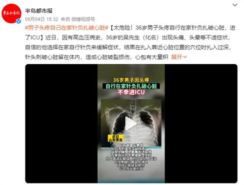 男子自己在家針灸扎破心臟，造成心臟破裂損傷大量積血