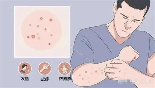 天津、長沙等地發(fā)現(xiàn)猴痘病例，猴痘病毒感染引發(fā)關(guān)注