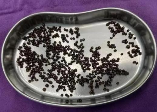 誤診為胃??！66歲王阿姨腹痛腹脹半年，最終發(fā)現(xiàn)膽囊結(jié)石
