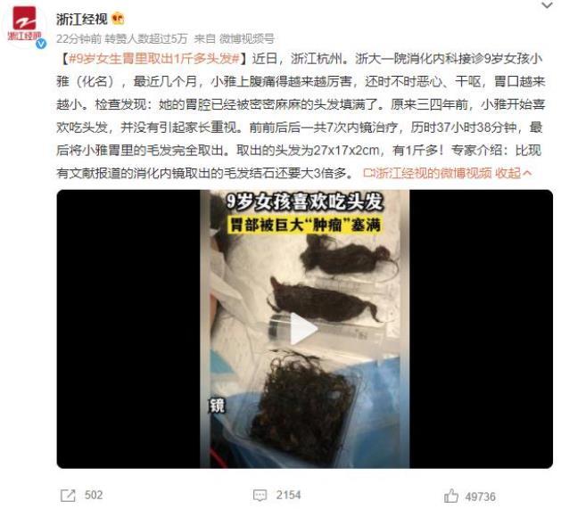 9歲女孩胃里取出1斤多頭發(fā)，醫(yī)生進(jìn)行長時(shí)間內(nèi)鏡治療